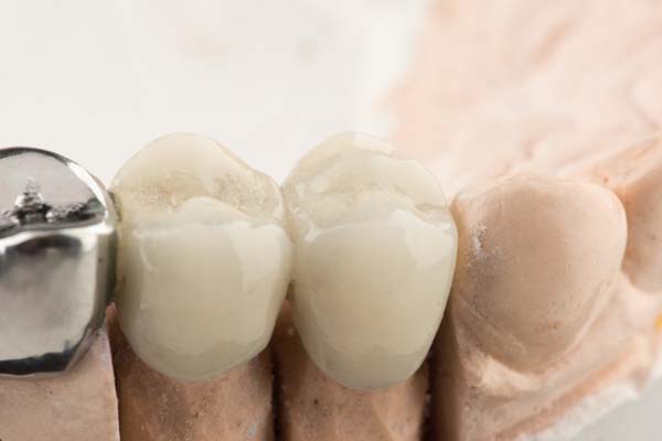 Replace Your Missing Teeth With A Dental Bridge