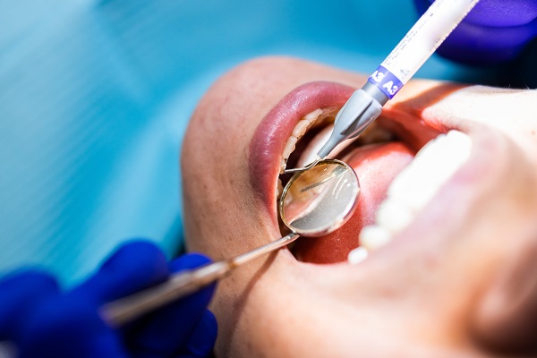 Three Questions To Ask Your Dentist About White Dental Fillings