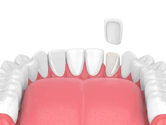 Ways To Prepare For Dental Veneers