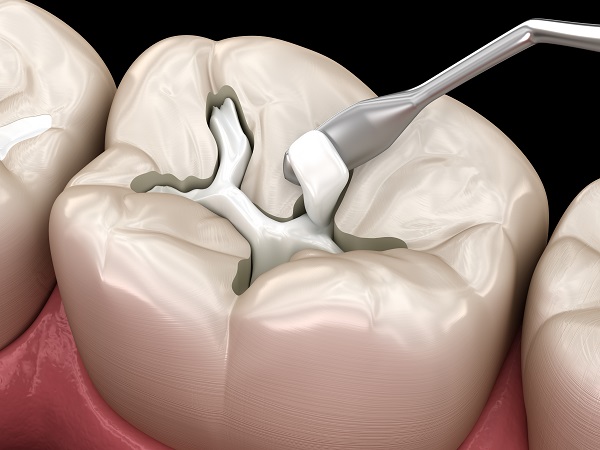 Questions And Answers About The Tooth Filling Process