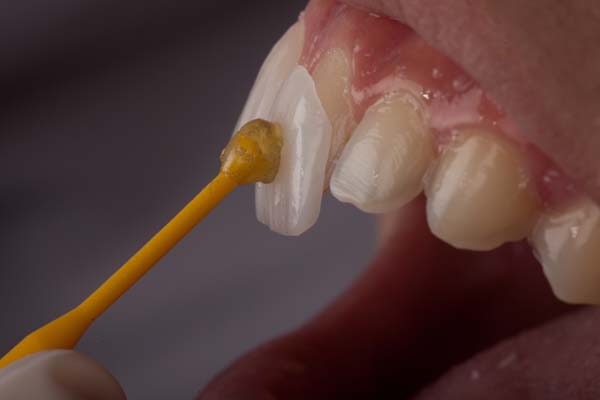 How To Know If You&#    ;re A Candidate For Dental Veneers